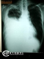 Chest X-ray of Tuberculosis- bilateral lung opacities, massive right pleural effusion