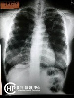 Chest X-ray of Tuberculosis-2 : bilateral upper zone shadow (RUZ shadow with cavity)