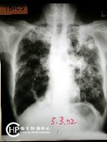 Chest X-ray of Tuberculosis-3 :extensive TB shadow both lung fields