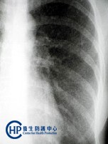 Chest X-ray of Tuberculosis-5 : miliary TB