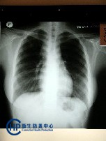 Chest X-ray of Tuberculosis-6 : TB mediastinal LN 