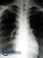 Chest X-ray of Tuberculosis-7 : TB mediastinal LN 