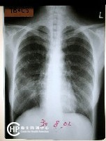 Chest X-ray of Tuberculosis-8 : miliary TB 